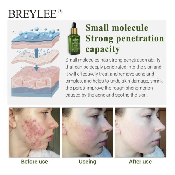 BREYLEE Acne Treatment Serum Face Facial Anti Acne Scar Removal Cream Skin Care Whitening Repair Pimple Remover For Acne - Image 3