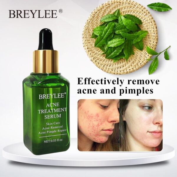 BREYLEE Acne Treatment Serum Face Facial Anti Acne Scar Removal Cream Skin Care Whitening Repair Pimple Remover For Acne - Image 6